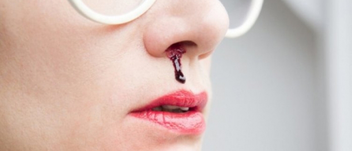 芳療會客室 - 又流鼻血，怎樣才能停止「失血」？